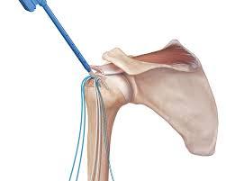 Shoulder Rotator Cuff repair